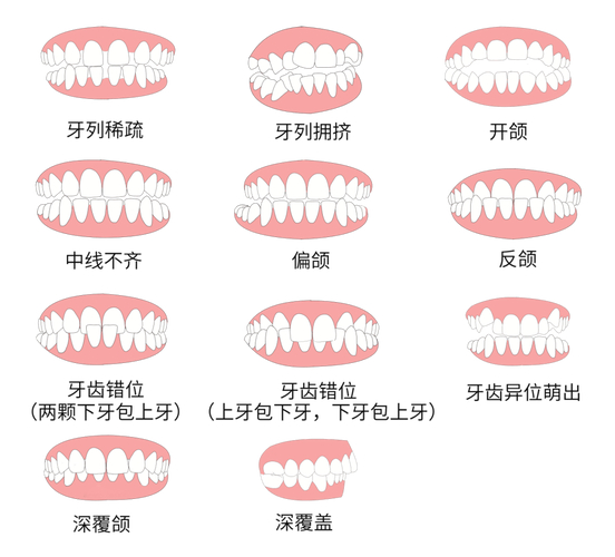 深圳30岁做牙齿矫正到底值不值 利与弊全分析
