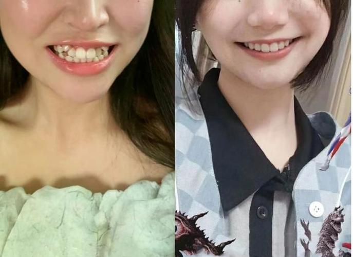 深圳36岁还能矫正牙齿吗 成人正畸的真相与风险