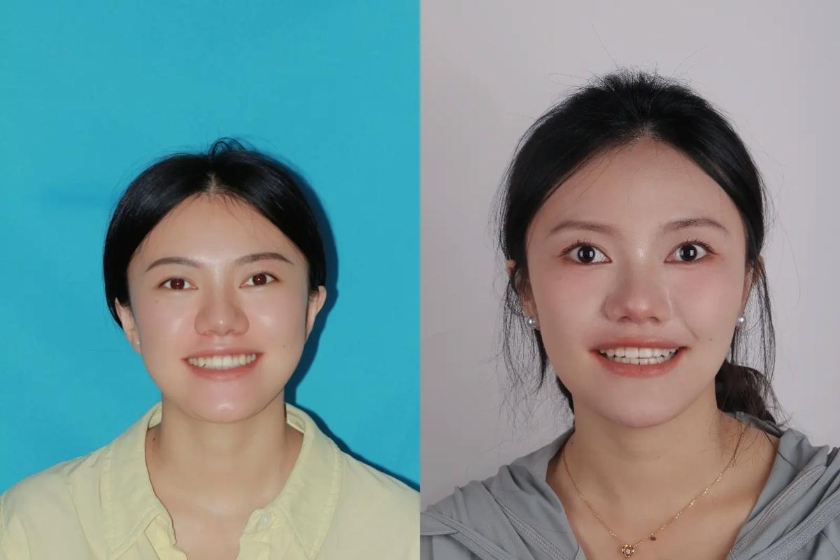 深圳20岁矫正牙齿晚不晚?过来人告诉你真实答案