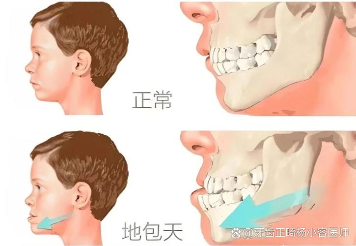 深圳12岁小孩能做牙齿矫正吗？别等换完牙才后悔
