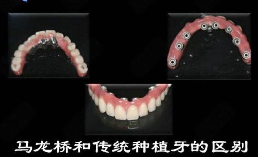深圳大同种牙哪里好 选公立还是私立更靠谱