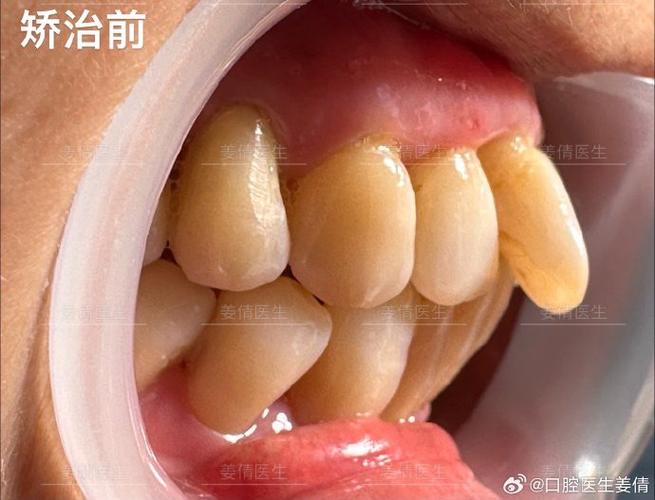 深圳60岁还能做牙齿矫正吗