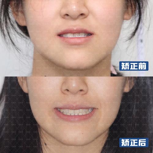 矫正地包天去医院还是去牙所_地包天能矫正四个牙齿吗_18岁女孩地包天牙能矫正吗