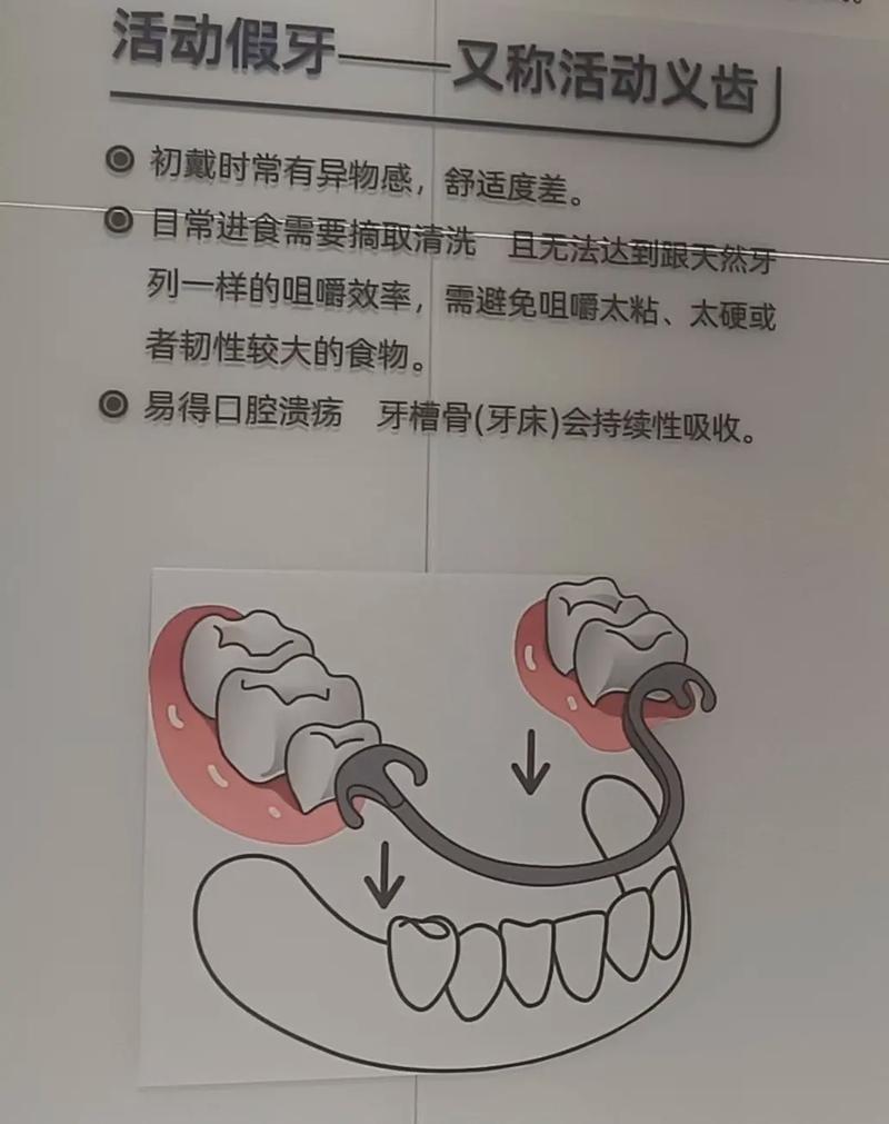 深圳活动假牙固定假牙种植牙哪个好 牙医一次说清别再被忽悠