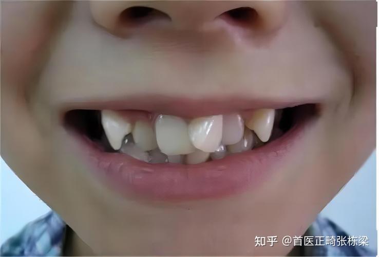 深圳儿童地包天最佳矫正年龄是多少?别等换牙误了大事