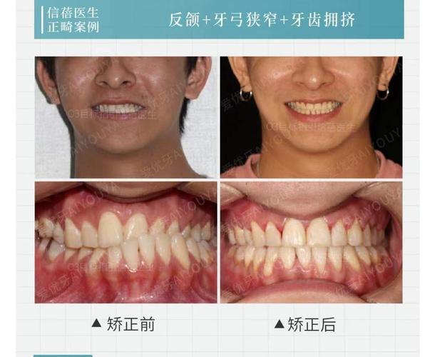 深圳中学生牙齿矫正优惠活动_中学生矫正牙齿需要注意事项_中学生牙齿矫正多少钱