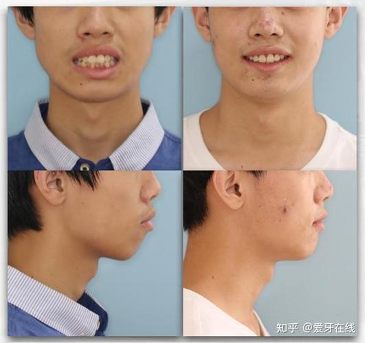 深圳呼和浩特牙齿矫正靠不靠谱?效果真实揭秘