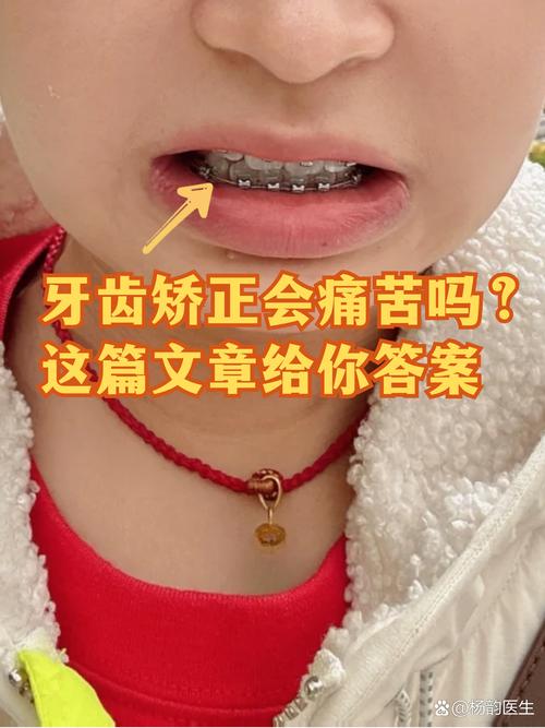 深圳19岁做牙齿矫正晚不晚 过来人告诉你真实经历