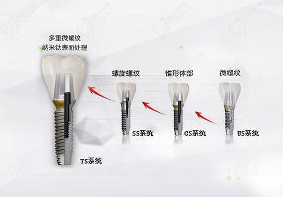 深圳唐山韩系奥齿泰种植牙2026最新费用一览