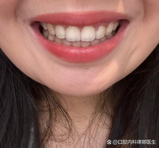 深圳23岁牙不齐还能整吗?正畸黄金期过了没