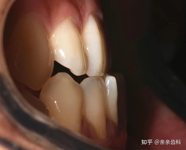 深圳宿迁牙齿矫正大概要花多少钱?本地人帮你算笔账