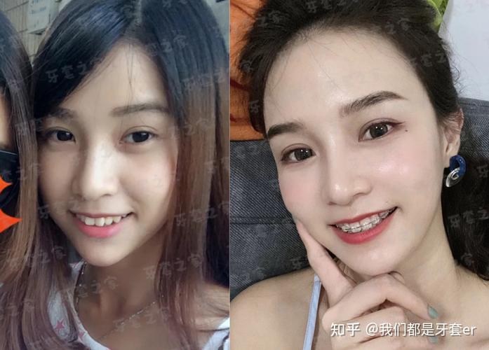 深圳43岁矫正深覆合牙齿要多少钱?从检查到摘牙套费用全掰扯清楚