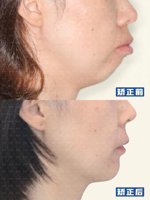 深圳矫正牙齿能改善下巴后缩吗?3个关键问题正畸医生一次说清