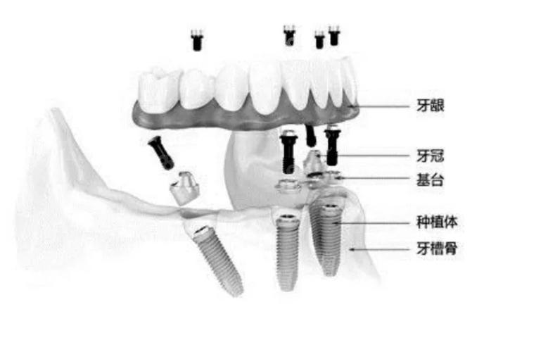 深圳半口种牙费用不固定 一颗大概多少钱