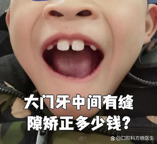 深圳保定矫正牙齿费用一览：一般多少钱？价格明细来了