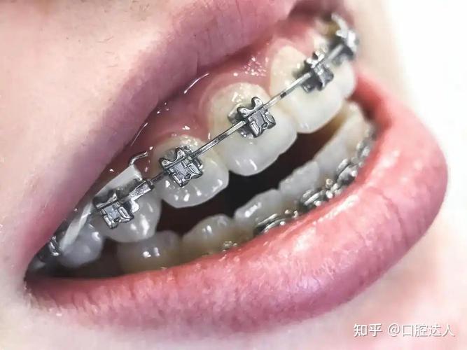 保定整牙多少钱_保定一般矫正牙齿多少钱_保定牙齿矫正钱一般多久能退