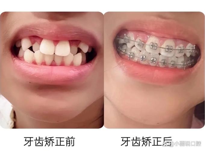长歪的牙齿能自己长正吗_长歪的牙齿怎样纠正_长歪的牙能矫正吗