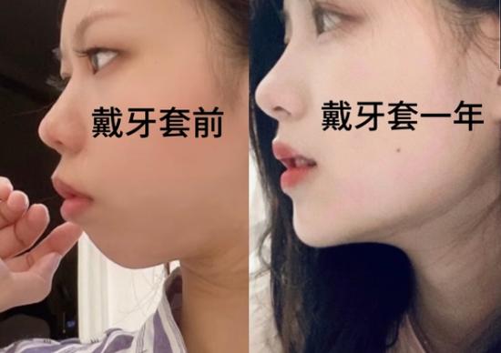 深圳郴州做牙齿矫正哪家好?看完这篇不踩坑