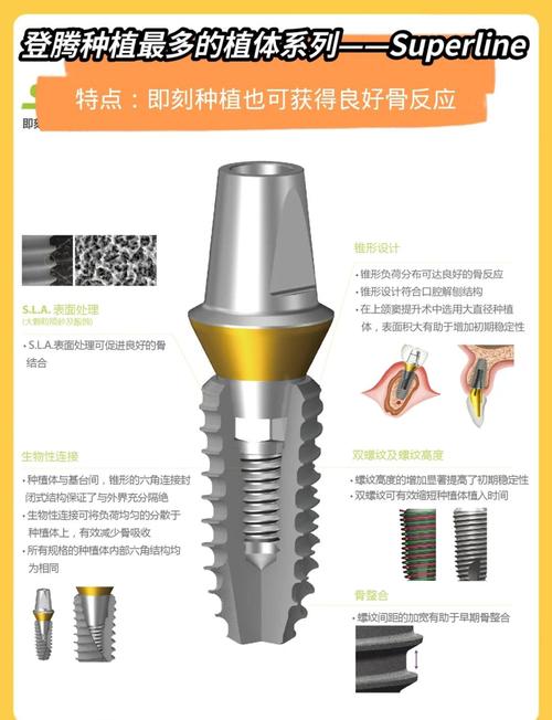 韩国登腾种植牙使用寿命_种植韩国登腾牙一颗多少钱_韩国登腾种植牙3999元一颗