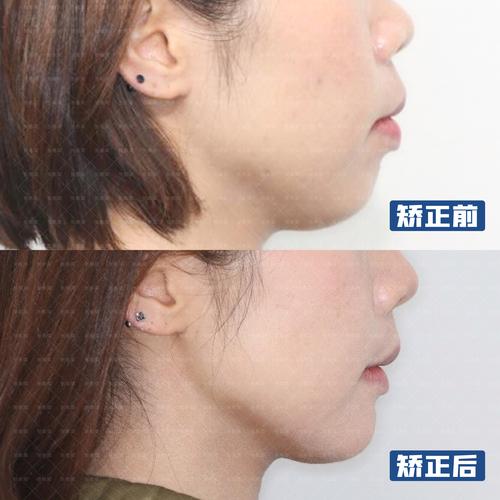 深圳30多岁做牙齿矫正晚吗?成人正畸的真相赶紧看