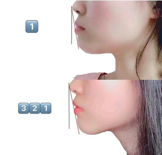 深圳34岁做龅牙矫正还来得及吗？我的真实感受