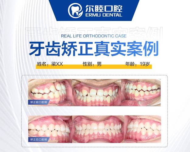 深圳成人牙齿矫正哪家医院好_深圳成人骨性龅牙矫正费用_成人矫正龅牙贴吧
