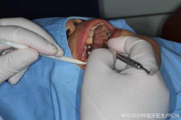 深圳80岁还能种牙吗?医生说只要满足这个条件就能做