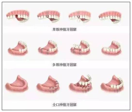 深圳半口种植牙全过程要多久?疼不疼?一步步讲清楚