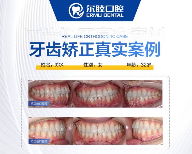 深圳成人矫正牙齿咬合疼不疼？效果和费用全解析
