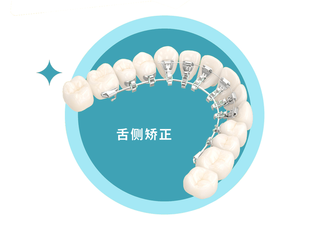 深圳成年人牙齿舌侧正畸到底值不值?看完这几点就懂了