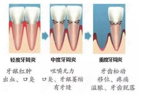 深圳牙周炎治疗到底要花多少钱?2026最新费用解析