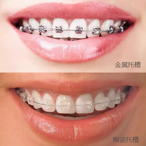深圳深覆合矫正费用大揭秘:到底多少钱才靠谱?