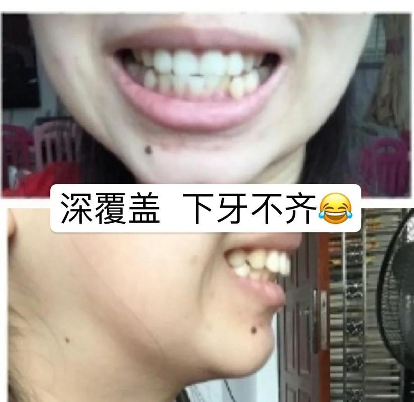 深圳39岁牙齿矫正还有用吗 真实效果看这里